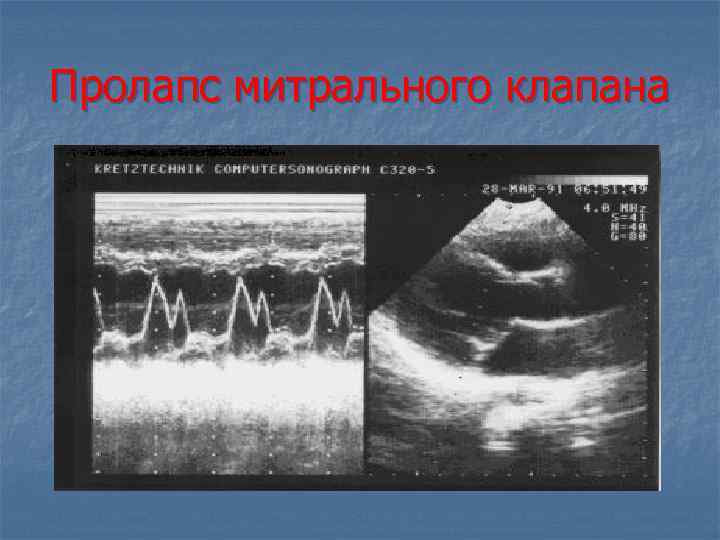 Пролапс митрального клапана 