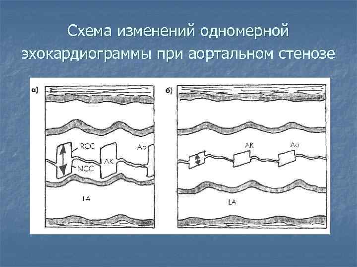 Схема изменений одномерной эхокардиограммы при аортальном стенозе 