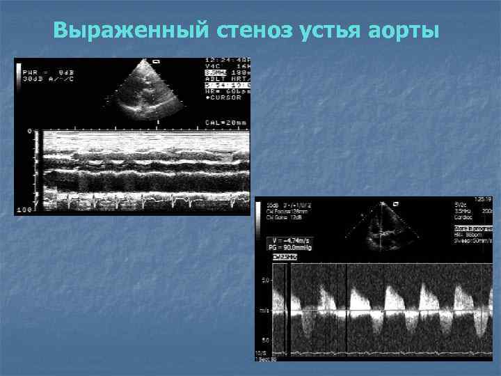 Выраженный стеноз устья аорты 