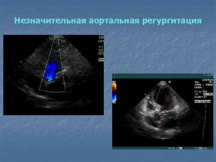 Незначительная аортальная регургитация 