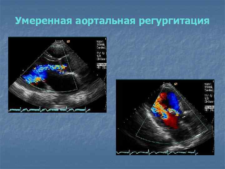 Умеренная аортальная регургитация 