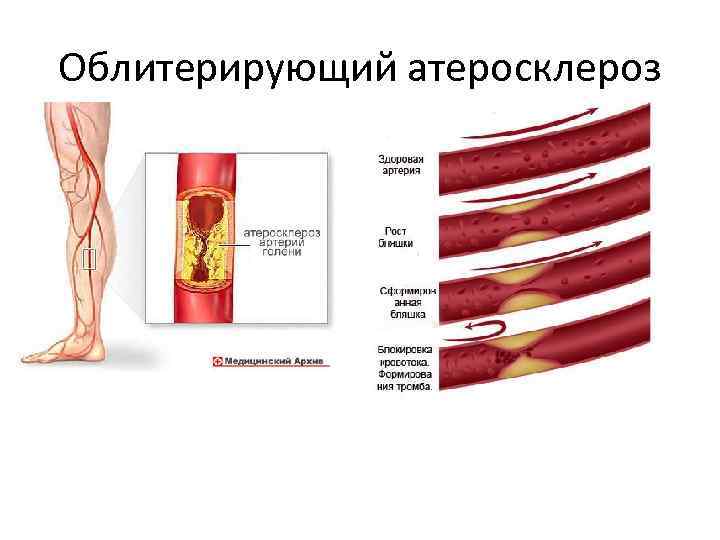 Облитерирующий атеросклероз 