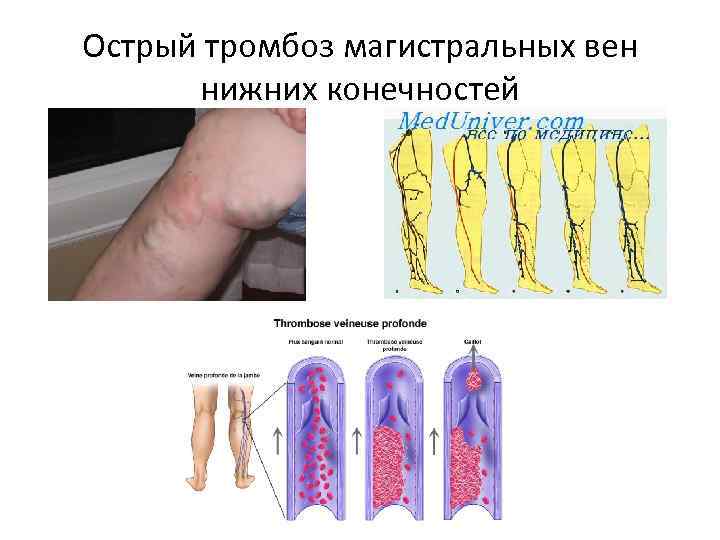 Острый тромбоз магистральных вен нижних конечностей 