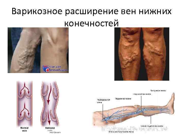 Варикозное расширение вен нижних конечностей 
