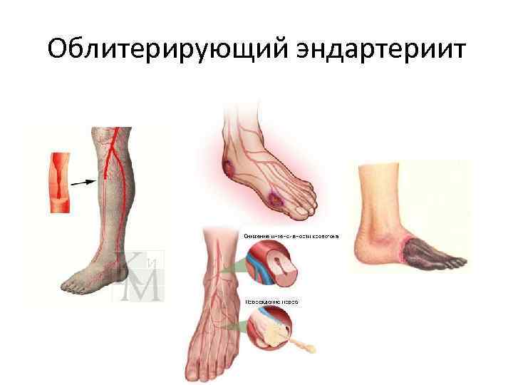 Облитерирующий эндартериит 