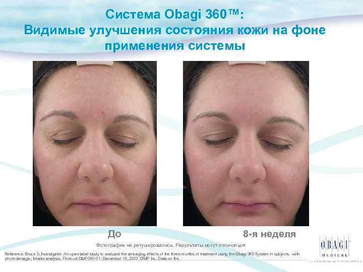 Система Obagi 360™: Видимые улучшения состояния кожи на фоне применения системы До 8 -я