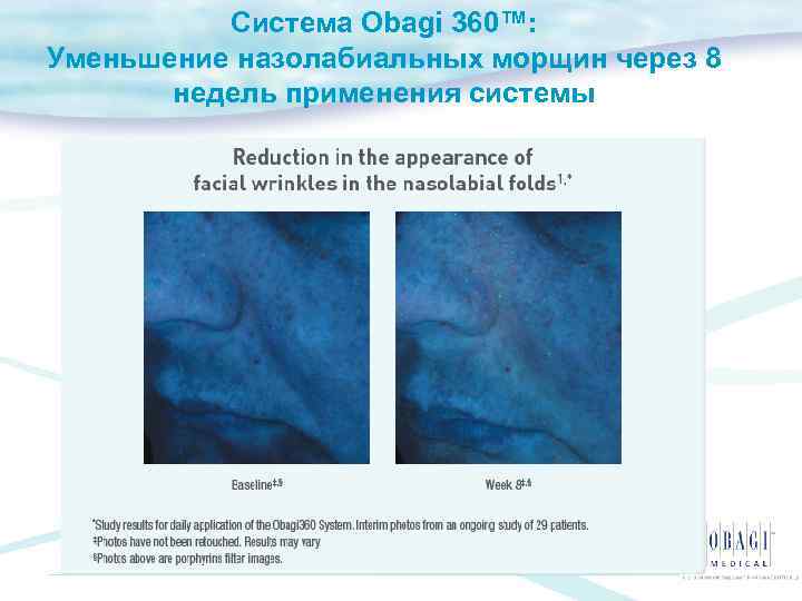 Система Obagi 360™: Уменьшение назолабиальных морщин через 8 недель применения системы 