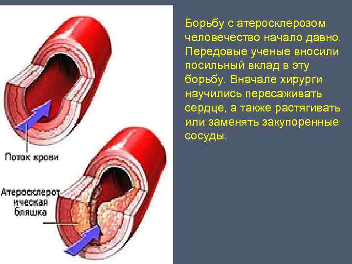 Борьба с атеросклерозом