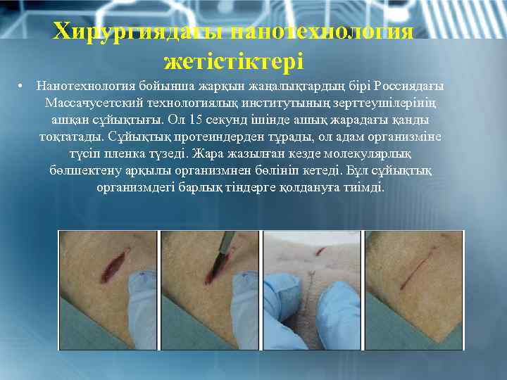Хирургиядағы нанотехнология жетістіктері • Нанотехнология бойынша жарқын жаңалықтардың бірі Россиядағы Массачусетский технологиялық институтының зерттеушілерінің