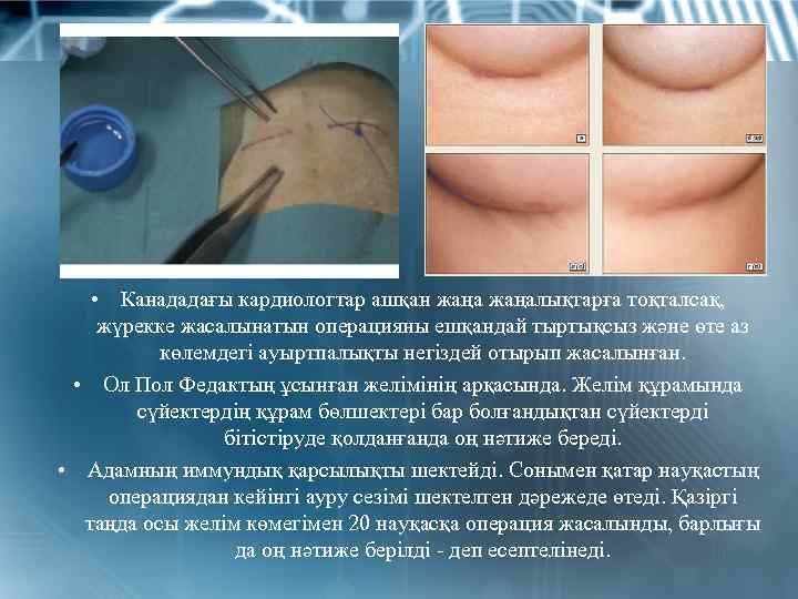  • Канададағы кардиологтар ашқан жаңалықтарға тоқталсақ, жүрекке жасалынатын операцияны ешқандай тыртықсыз және өте