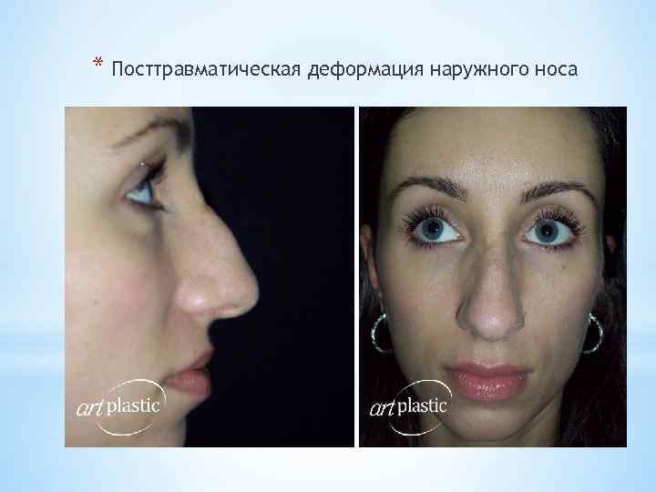 * Посттравматическая деформация наружного носа 