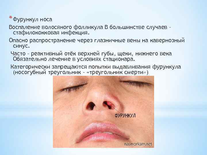 * Фурункул носа Воспаление волосяного фолликула В большинстве случаев – стафилококковая инфекция. Опасно распространение