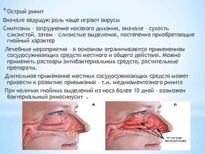 * Острый ринит Вначале ведущую роль чаще играют вирусы Симптомы – затруднение носового дыхания,