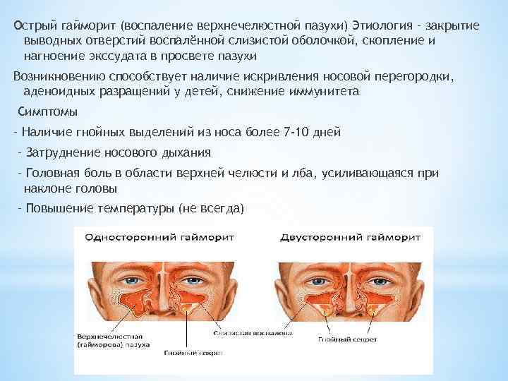 Острый гайморит (воспаление верхнечелюстной пазухи) Этиология – закрытие выводных отверстий воспалённой слизистой оболочкой, скопление