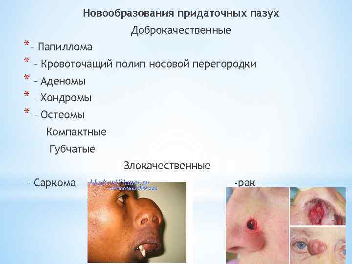 Новообразования придаточных пазух Доброкачественные *– Папиллома * – Кровоточащий полип носовой перегородки * –