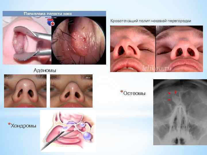 * Кровоточащий полип носовой перегородки Аденомы *Остеомы *Хондромы 