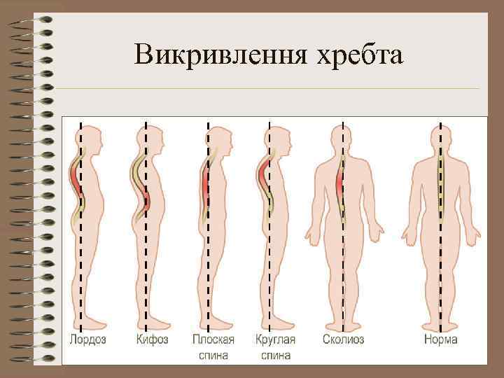 Викривлення хребта 