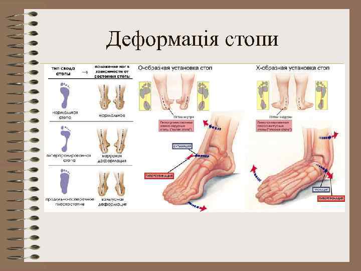 Деформація стопи 