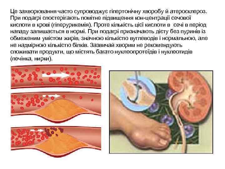 Це захворювання часто супроводжує гіпертонічну хворобу й атеросклероз. При подагрі спостерігають помітне підвищення кон