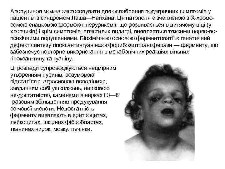 Алопуринол можна застосовувати для ослаблення подагричних симптомів у пацієнтів із синдромом Леша—Найхана. Ця патологія