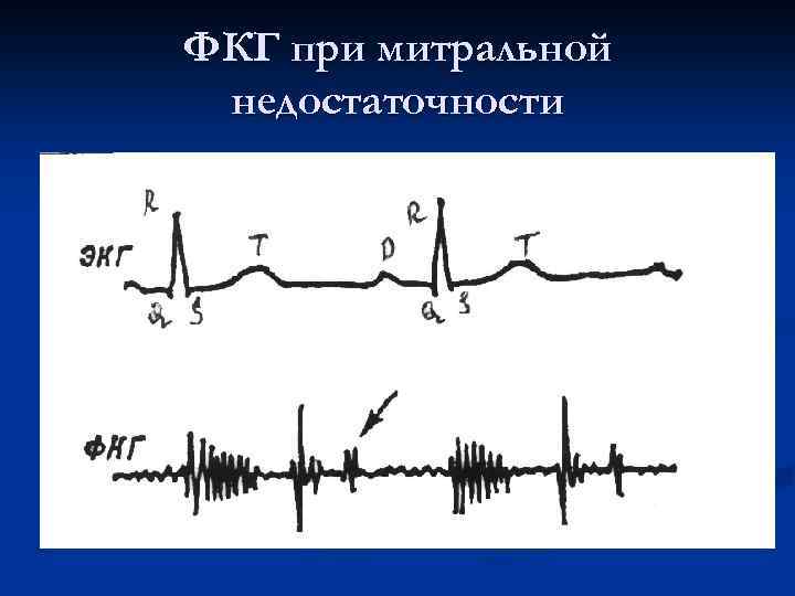 ФКГ при митральной недостаточности 