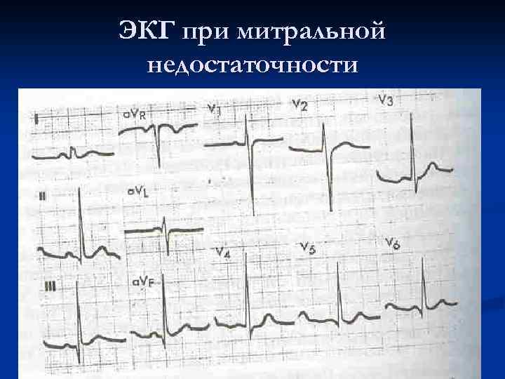 ЭКГ при митральной недостаточности 