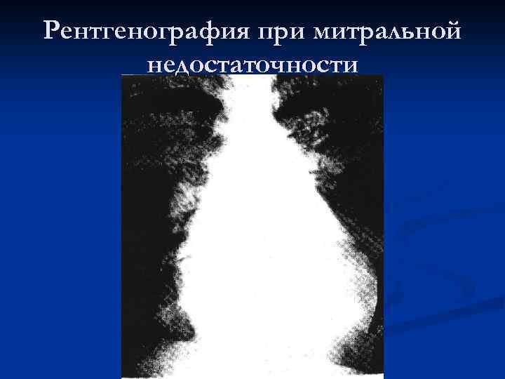 Рентгенография при митральной недостаточности 
