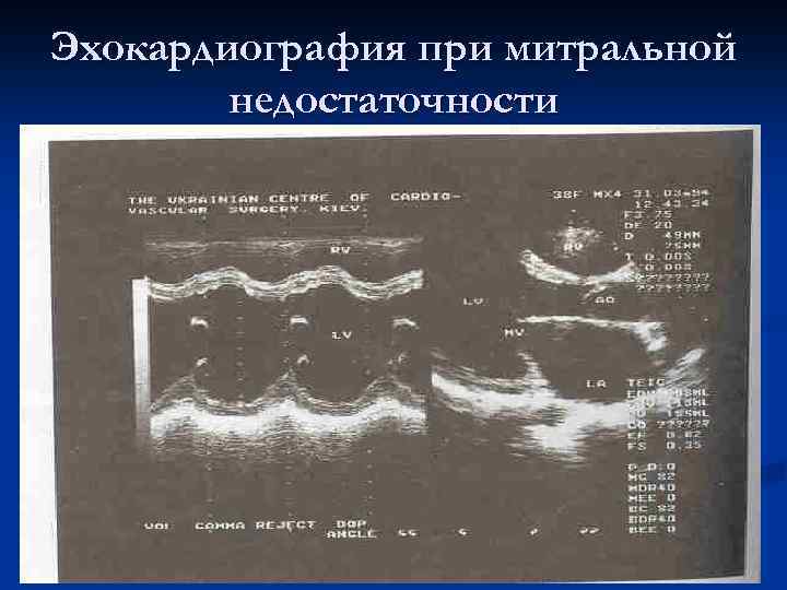 Эхокардиография при митральной недостаточности 