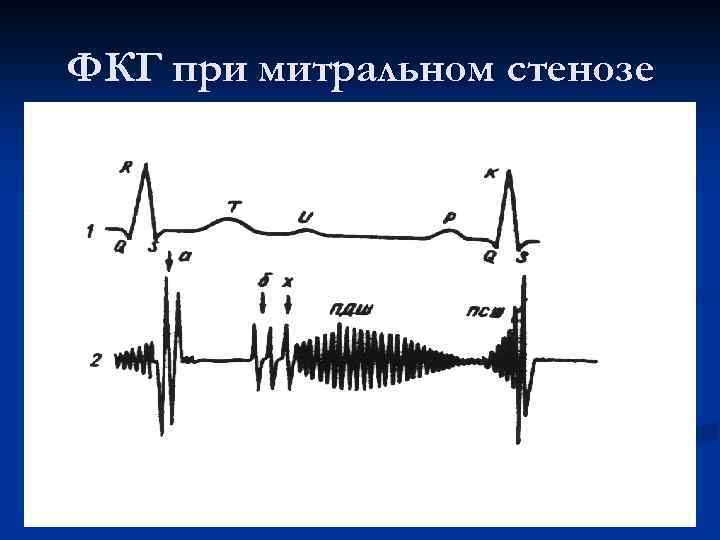 ФКГ при митральном стенозе 