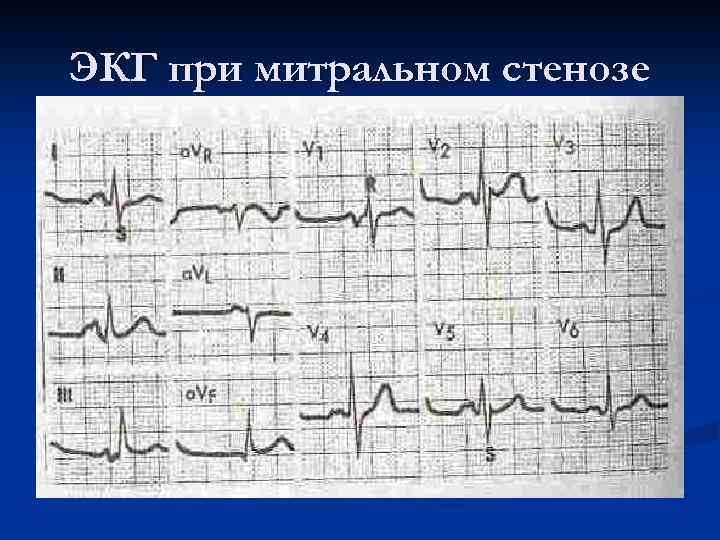 ЭКГ при митральном стенозе 