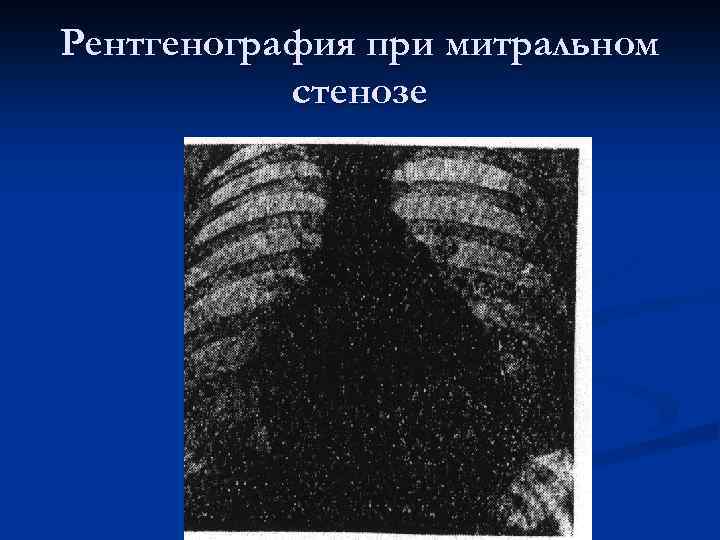 Рентгенография при митральном стенозе 