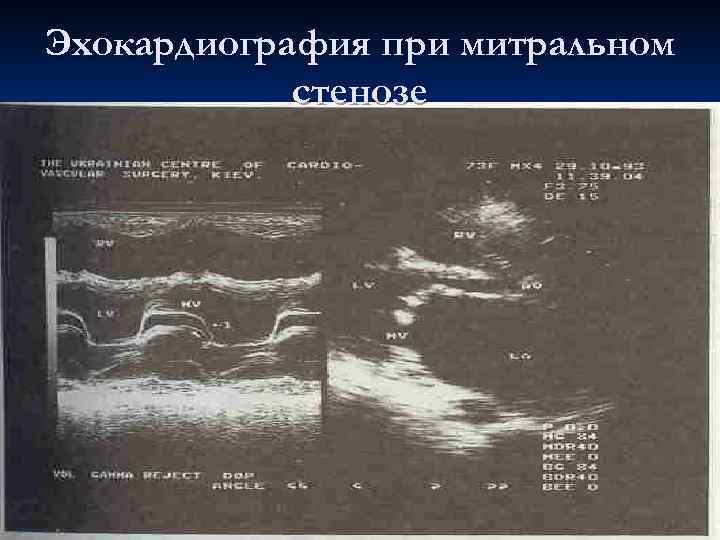 Эхокардиография при митральном стенозе 