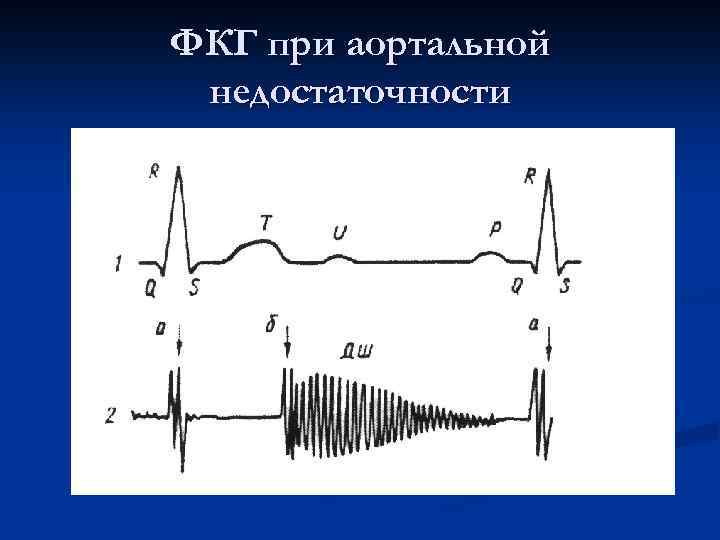 ФКГ при аортальной недостаточности 