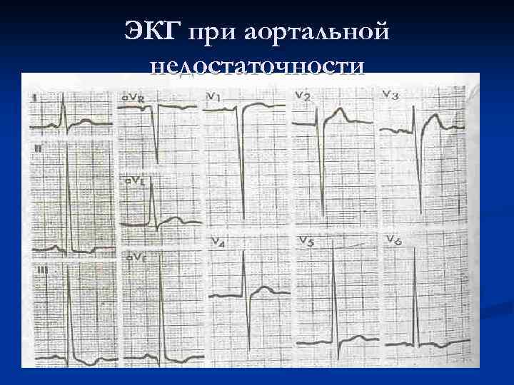 ЭКГ при аортальной недостаточности 