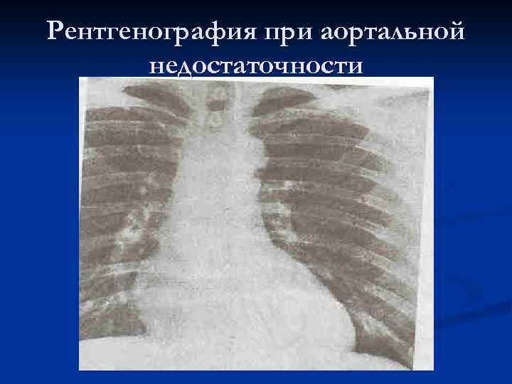 Рентгенография при аортальной недостаточности 