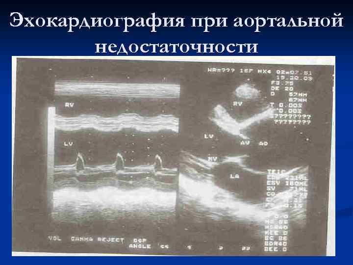 Эхокардиография при аортальной недостаточности 