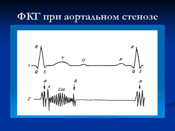 ФКГ при аортальном стенозе 
