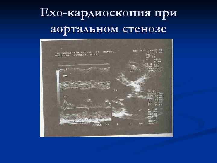 Ехо-кардиоскопия при аортальном стенозе 