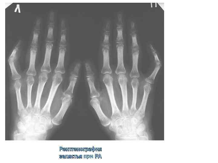 Рентгенография запястья при РА 