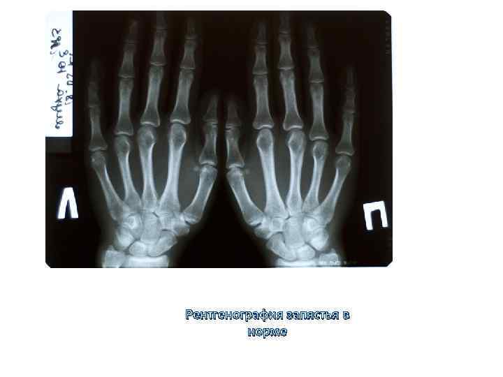 Рентгенография запястья в норме 