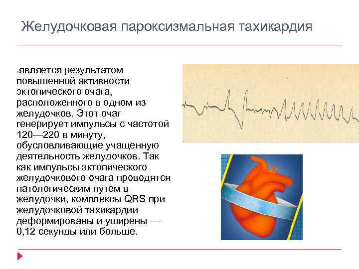 Желудочковая пароксизмальная тахикардия является результатом повышенной активности эктопического очага, расположенного в одном из желудочков.