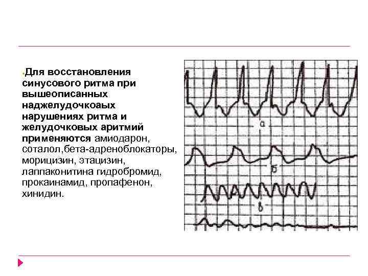 Для восстановления синусового ритма при вышеописанных наджелудочкоаых нарушениях ритма и желудочковых аритмий применяются амиодарон,