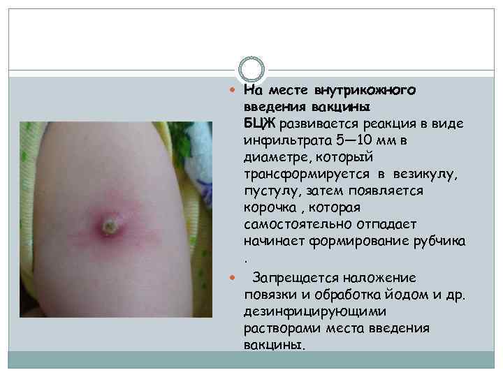  На месте внутрикожного введения вакцины БЦЖ развивается реакция в виде инфильтрата 5— 10