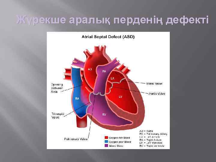 Жүрекше аралық перденің дефекті 