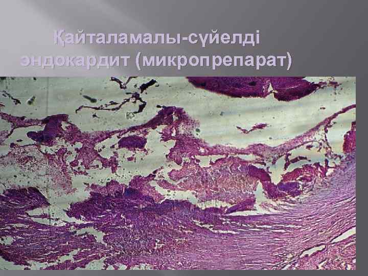 Қайталамалы-сүйелді эндокардит (микропрепарат) 