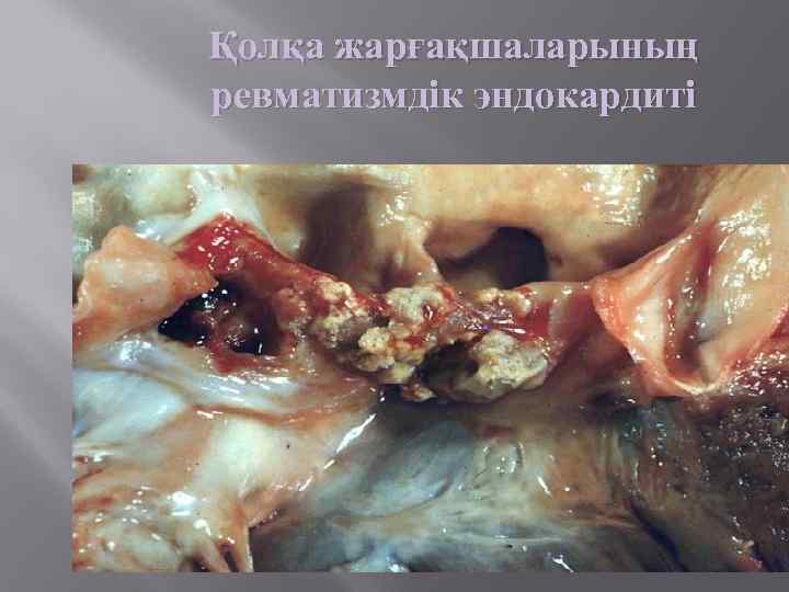 Қолқа жарғақшаларының ревматизмдік эндокардиті 