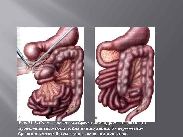 Рис. 21 -3. Схематическое изображение синдрома Ледда: а - до проведения эндоскопических манипуляций; б