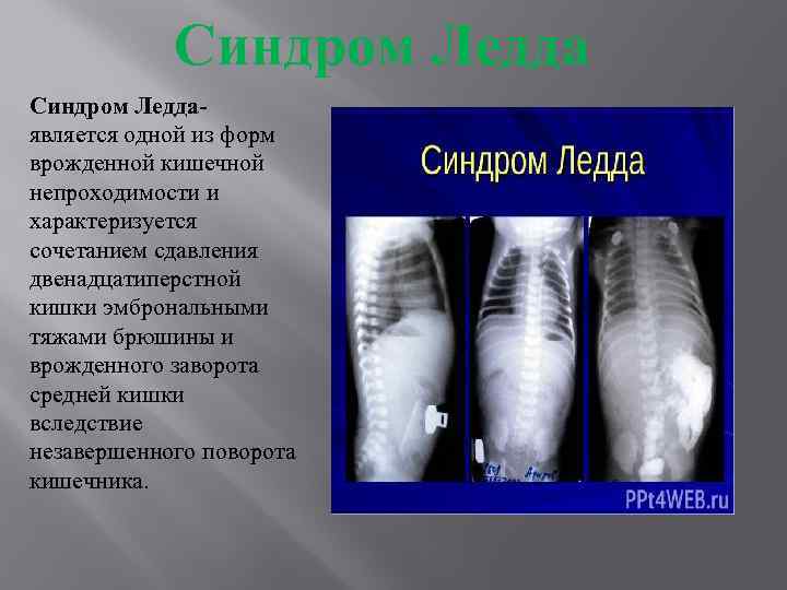 Синдром Ледда- является одной из форм врожденной кишечной непроходимости и характеризуется сочетанием сдавления двенадцатиперстной