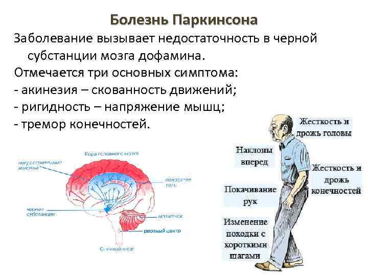 Болезнь Паркинсона Заболевание вызывает недостаточность в черной субстанции мозга дофамина. Отмечается три основных симптома: