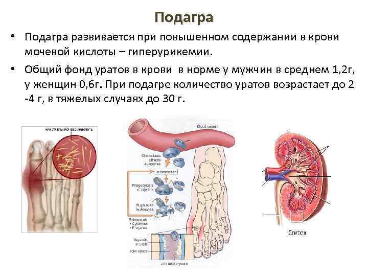 Подагра • Подагра развивается при повышенном содержании в крови мочевой кислоты – гиперурикемии. •